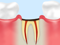 C4 歯根に達したむし歯